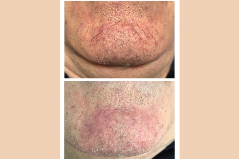 Klinika Venus Center, Kirurgji Dermatologjike me laser ne fytyre, kirurg...