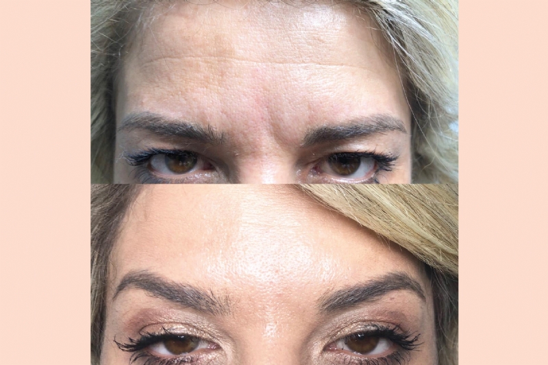 Klinika Venus Center, mbushje rrudhash me Acid Hyalurinik dhe Botox, Las...