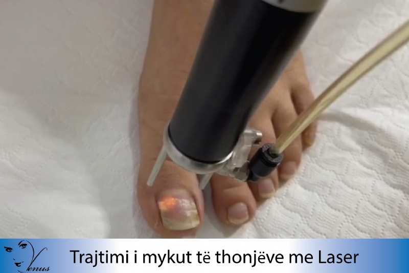 Trajtim i kapilareve me Laser, Trajtimi mykut te thonjeve me Laser, Traj...